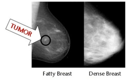 Fatty vs Dense Breast Ultrasound