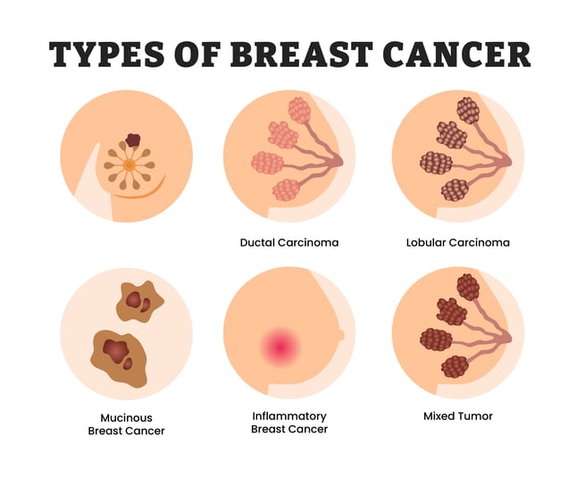 Inflammatory breast cancer image
