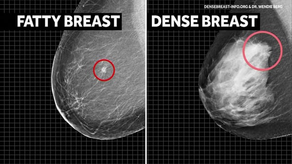 breast cancer ultrasound image
