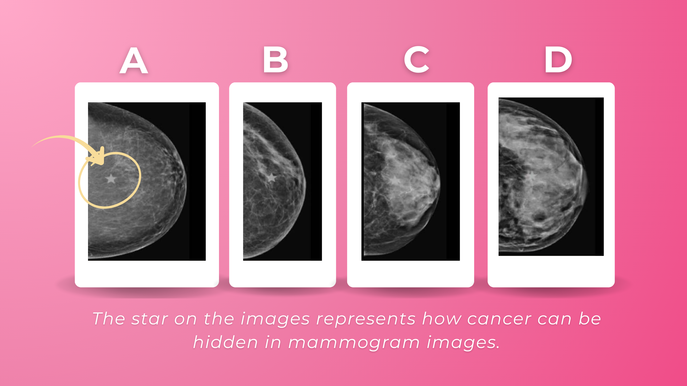 dense breast categories