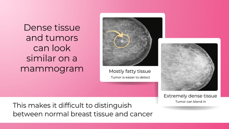 dense breast tissue