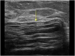 implant rupture on ultrasound