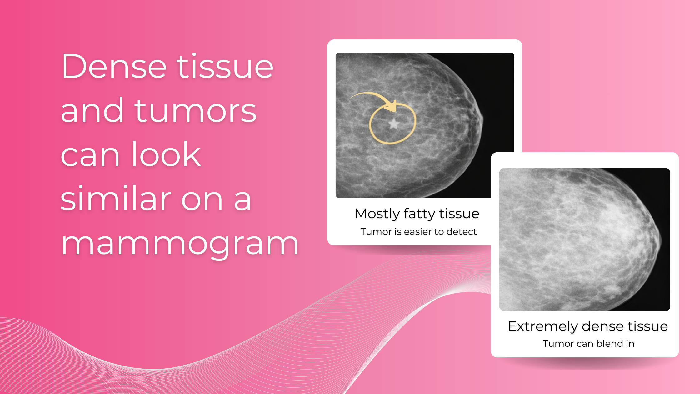 Breast Screening Ultrasound | | Breast Cancer Screening | HerScan