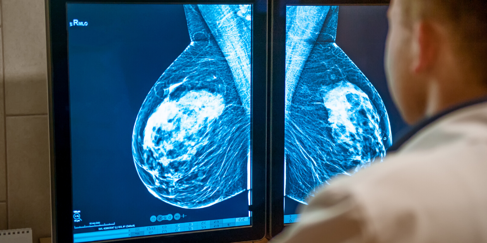 Breast Ultrasound vs Mammogram